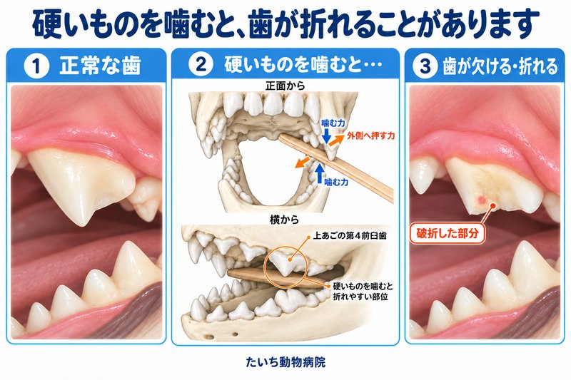 正常な歯、硬いものを噛むときの力、破折した歯を示す図解