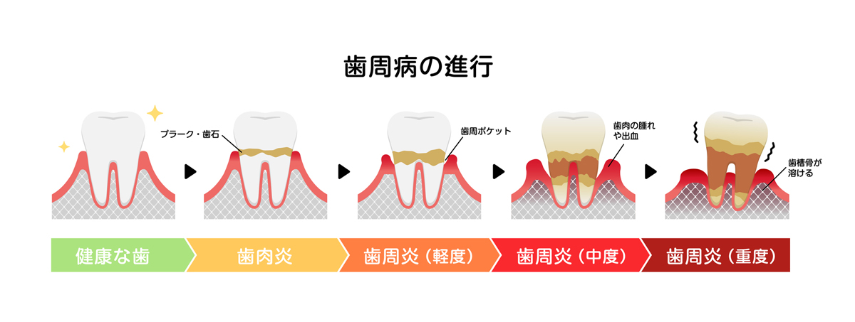 歯周病の進行